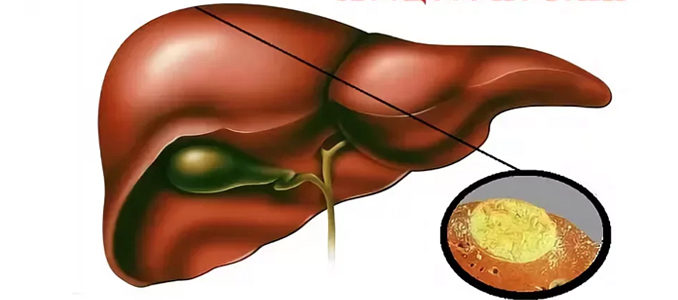 Печень желчный пузырь жировая