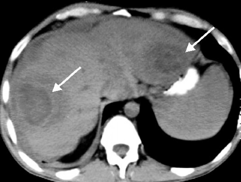Абсцесс печени кт картина