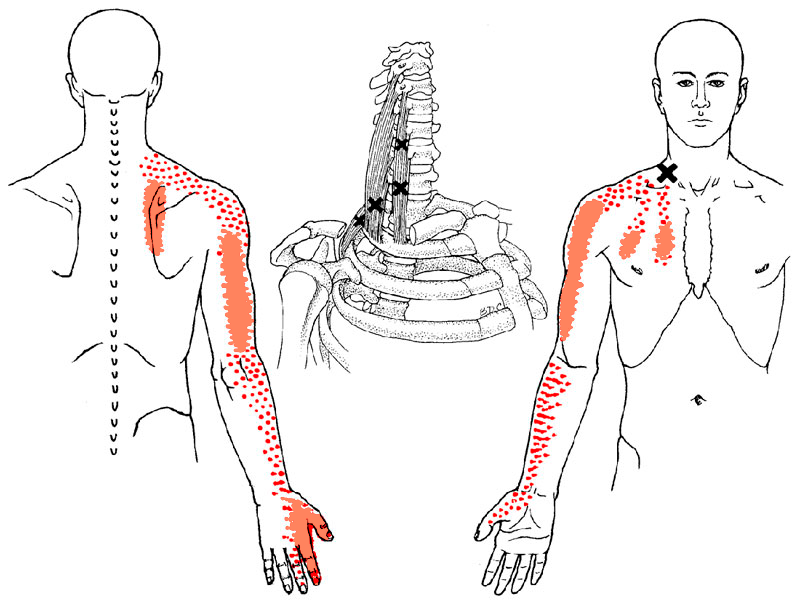 Синдром мышцы. Лестничные мышцы триггерные точки. Триггерные точки синдром лестничной мышцы. Миофасциальные триггерные точки шеи. Триггерные точки в лестничных мышцах шеи.