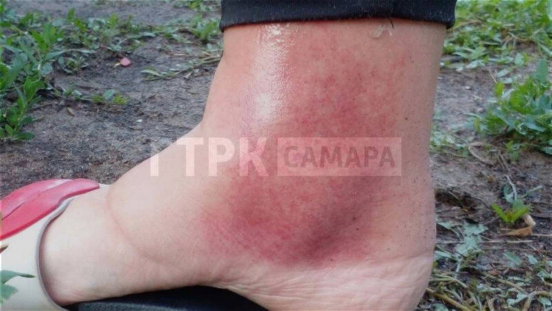     Место укуса. ГТРК Самара