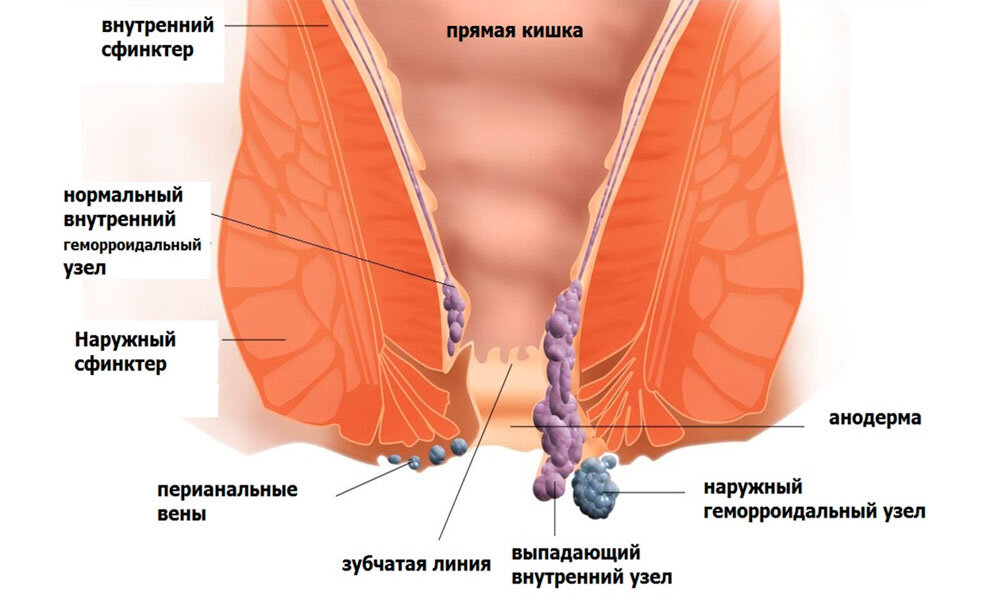 Геморрой у женщин