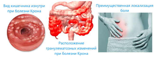 Болезнь Крона - Заболевания желудочно-кишечного тракта - Справочник MSD Профессиональная версия