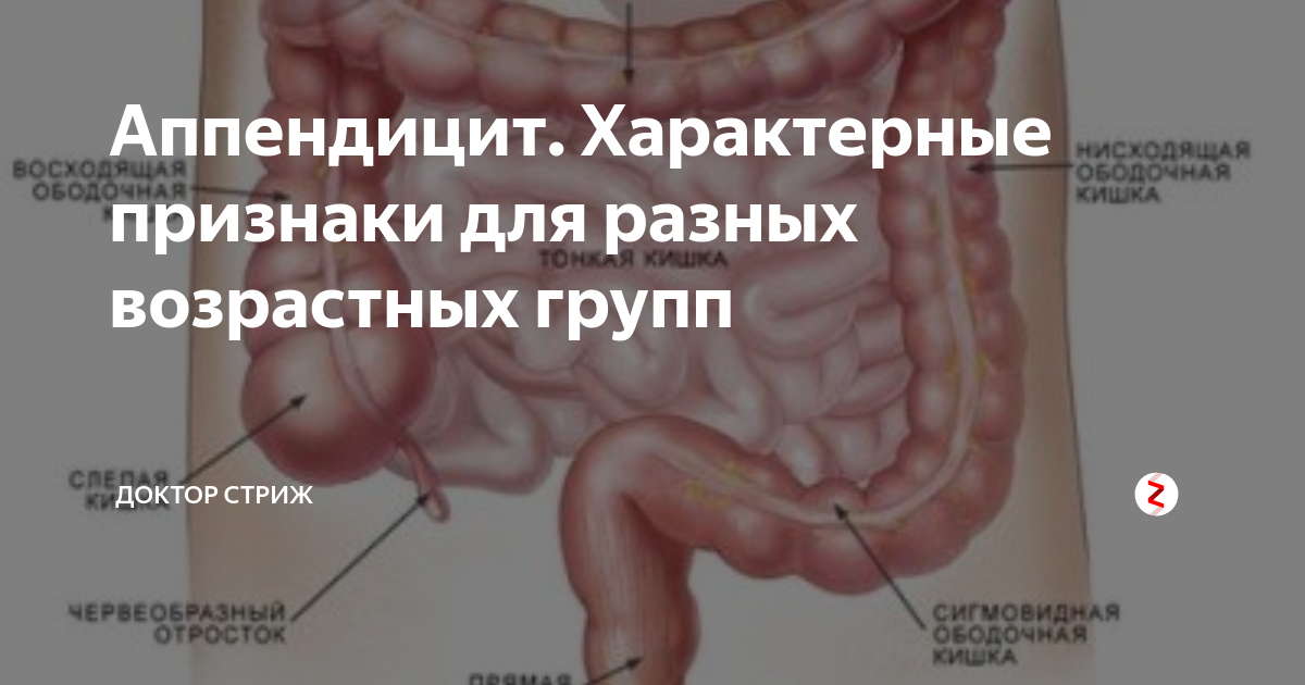 Признаки аппендицита у мужчин. Расположение аппендикса в брюшной полости.