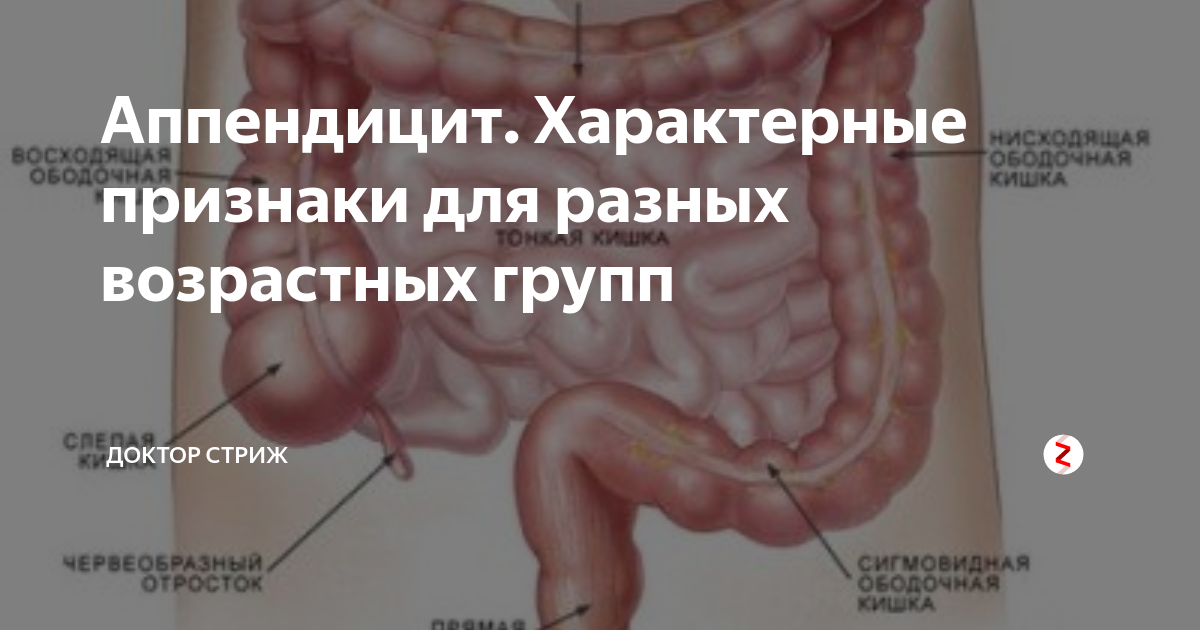 Место расположения аппендикса. Расположение аппендицита у мужчин. Расположение аппендицита у человека.