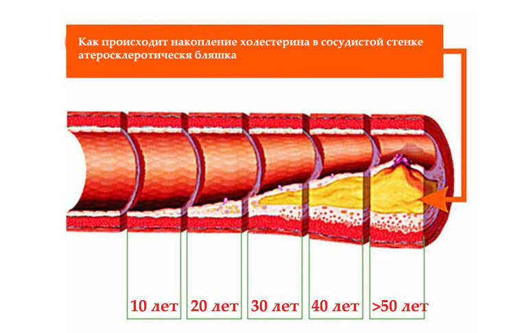 Как накапливается холестерин в сосудах в зависимости от возраста