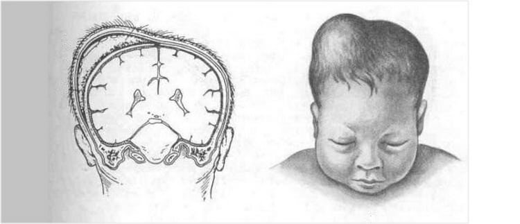 источник фото:https://okrohe.com/deti/problemy/kefalogematoma-u-novorozhdennyh.html