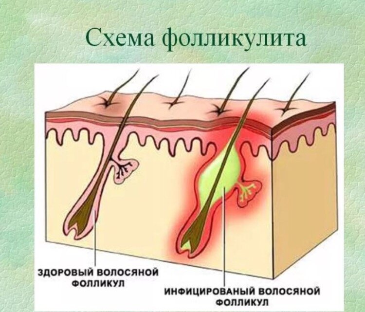 Схема фолликулита
