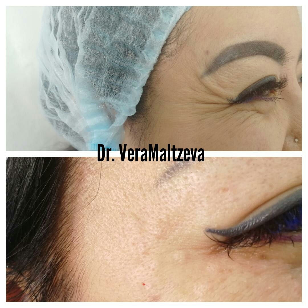 Ботулинотерапия - называют процедуру обеденного перерыва!! Процедура направленна на снять гипертонус мышц. Окончательный результат мы видим через 2 неделе!! 