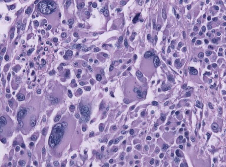    Клетки глиобластомы под микроскопом / ©Getty images