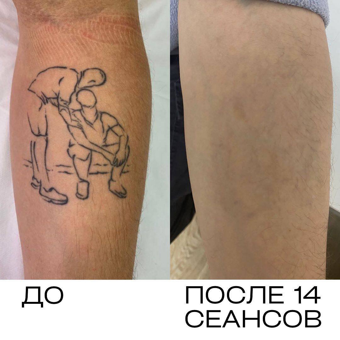 Убрать тату на фото