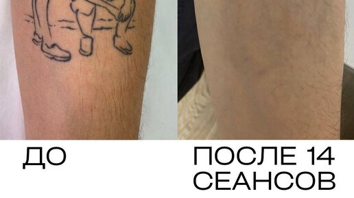 Удаление татуировки на руке йодом