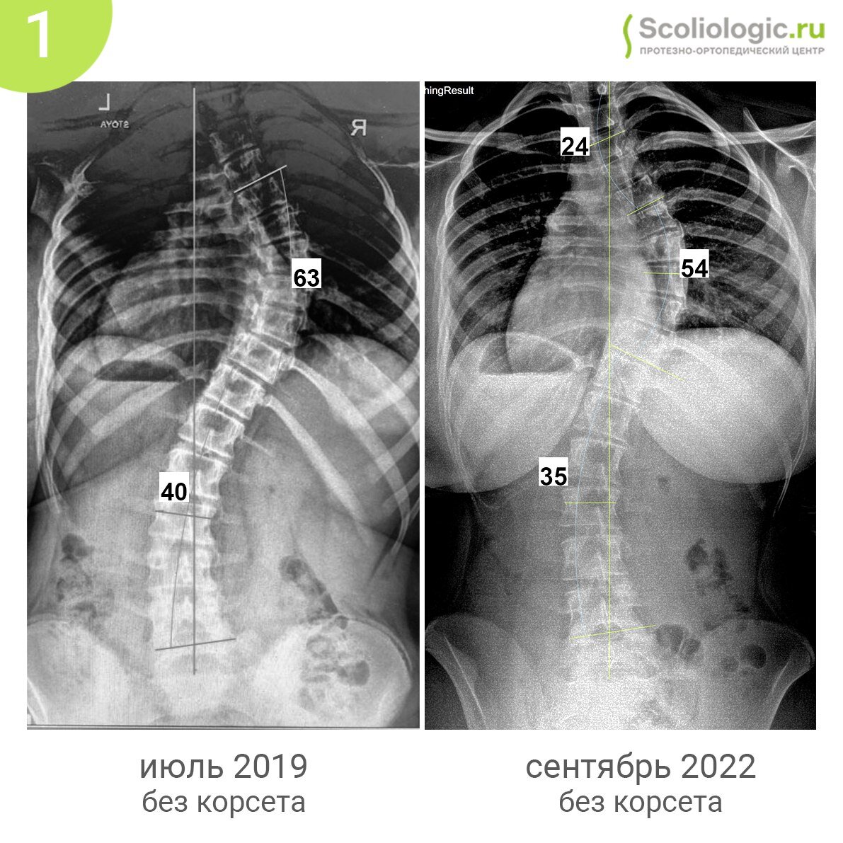 Степени сколиоза рентген