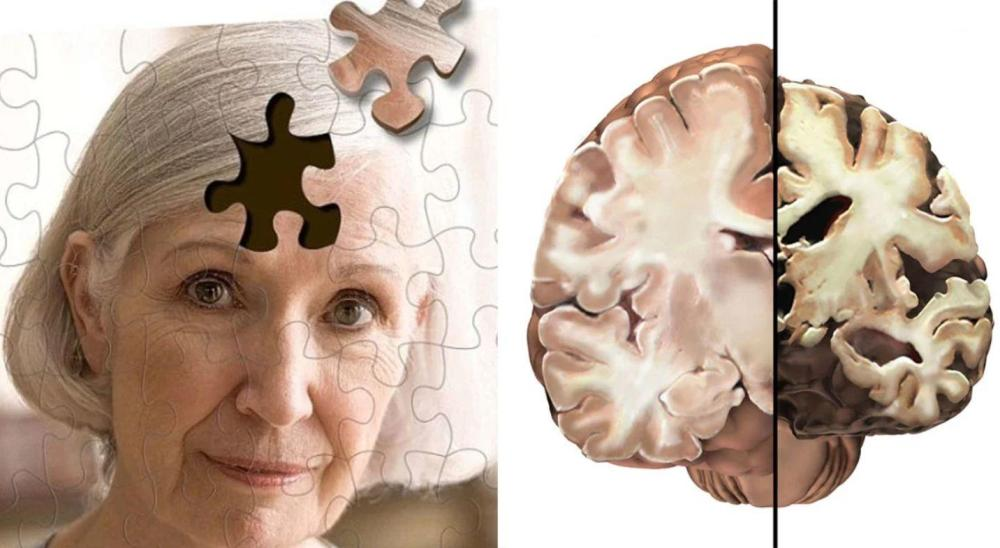 Brain old. Болезнь Альцгеймера деменция. Старение головного мозга. Деменция головного мозга.