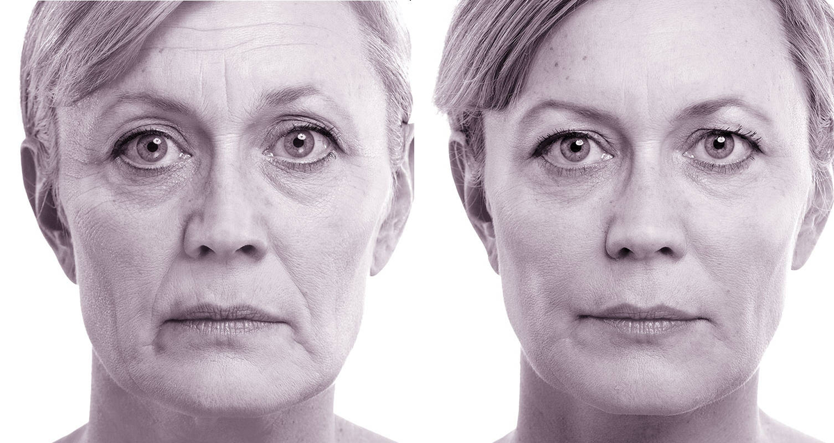 Возрастные изменения лица в 40 лет. Массаж для деформационного типа старения лица. Деформационный Тип старения с пигментацией. Треугольник молодости лица до и после. Коррекция возрастных изменений