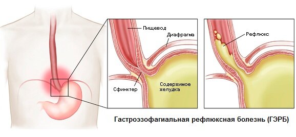 Лечение ГЭРБ (гастроэзофагеального рефлюкса)