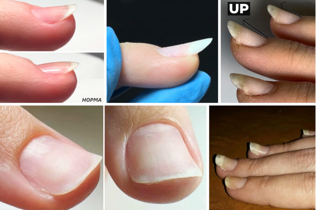 Загибаются ногти что делать. Искривление ногтевой пластины. Неровности на ногтевой пластине. Естественные ногти.