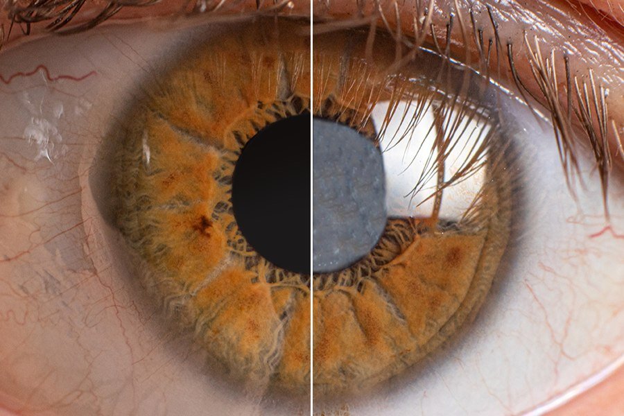 История пациента о победе над катарактой. | VISTA центр инновационной ...