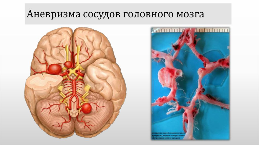 Аневризма сосудов головного мозга презентация