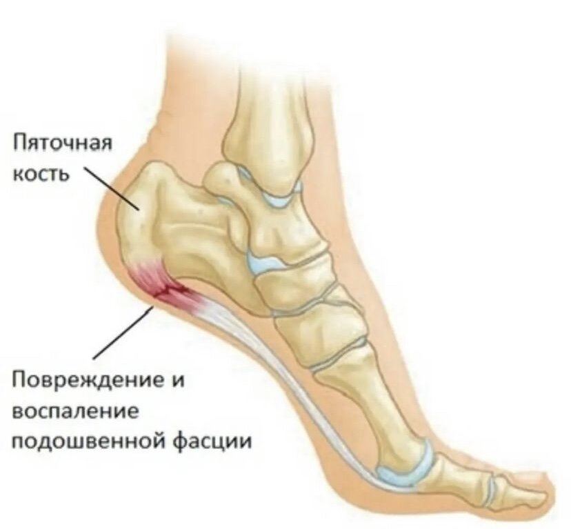 Болит внутри пятки при ходьбе