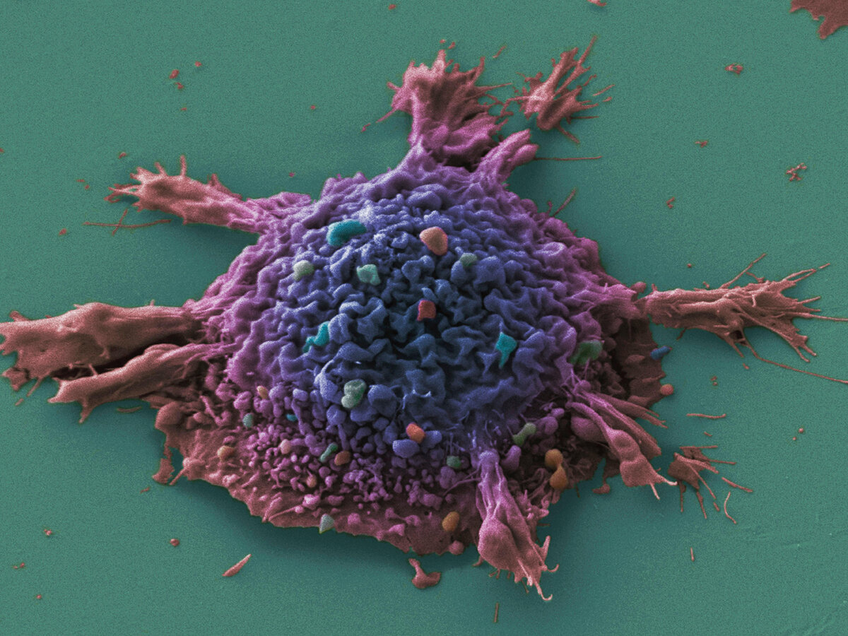 Рак живой организм. Клетки раковой опухоли под микроскопом. Раковые клетки микрофотографии.