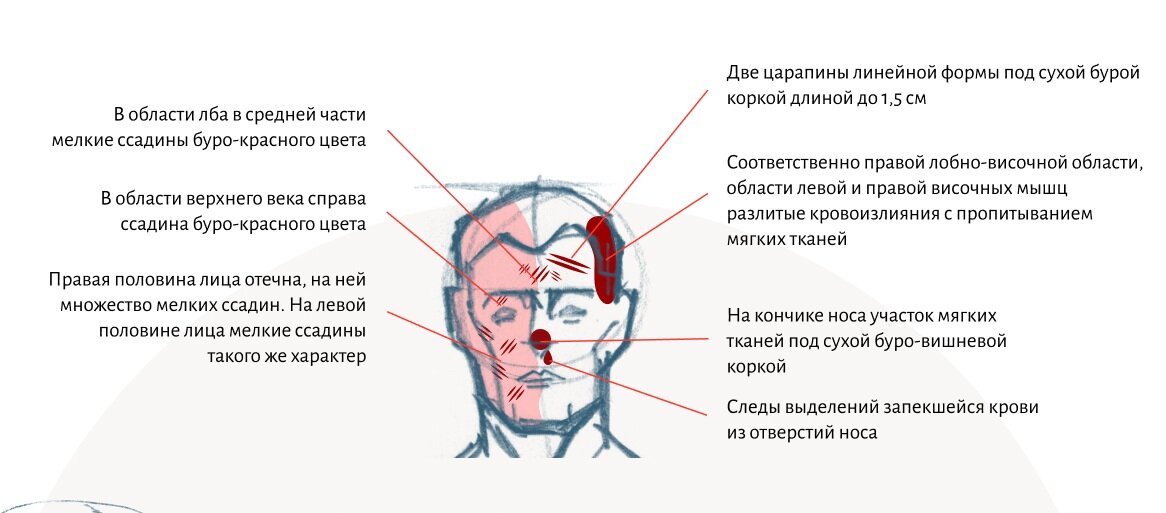 Схема повреждения дятловцев травм травмы. Правая горит лицо