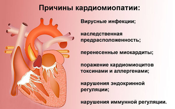 Лечение кардиомиопатии