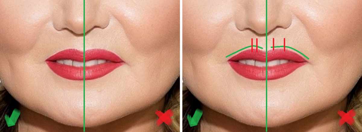 Обратите внимание, у правой части губы акра Купидона уехала