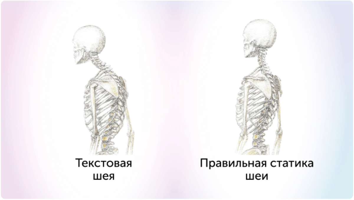 С повсеместным распространением гаджетов все чаще стало мелькать в Сети такое понятие, как «текстовая шея», или синдром компьютерной шеи.-2