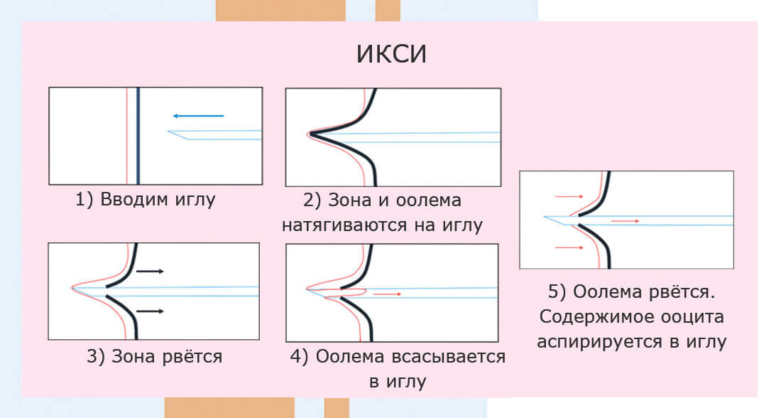 Как проходит ИКСИ