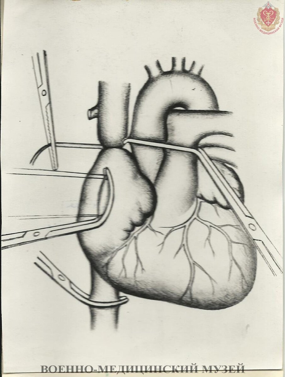 Хирургия органов грудной полости. Схема выключения сердца из кровообращения.