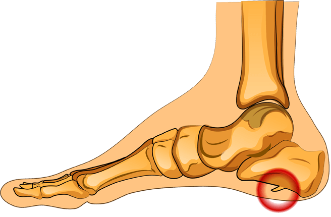 Вот как выглядит пяточная шпора