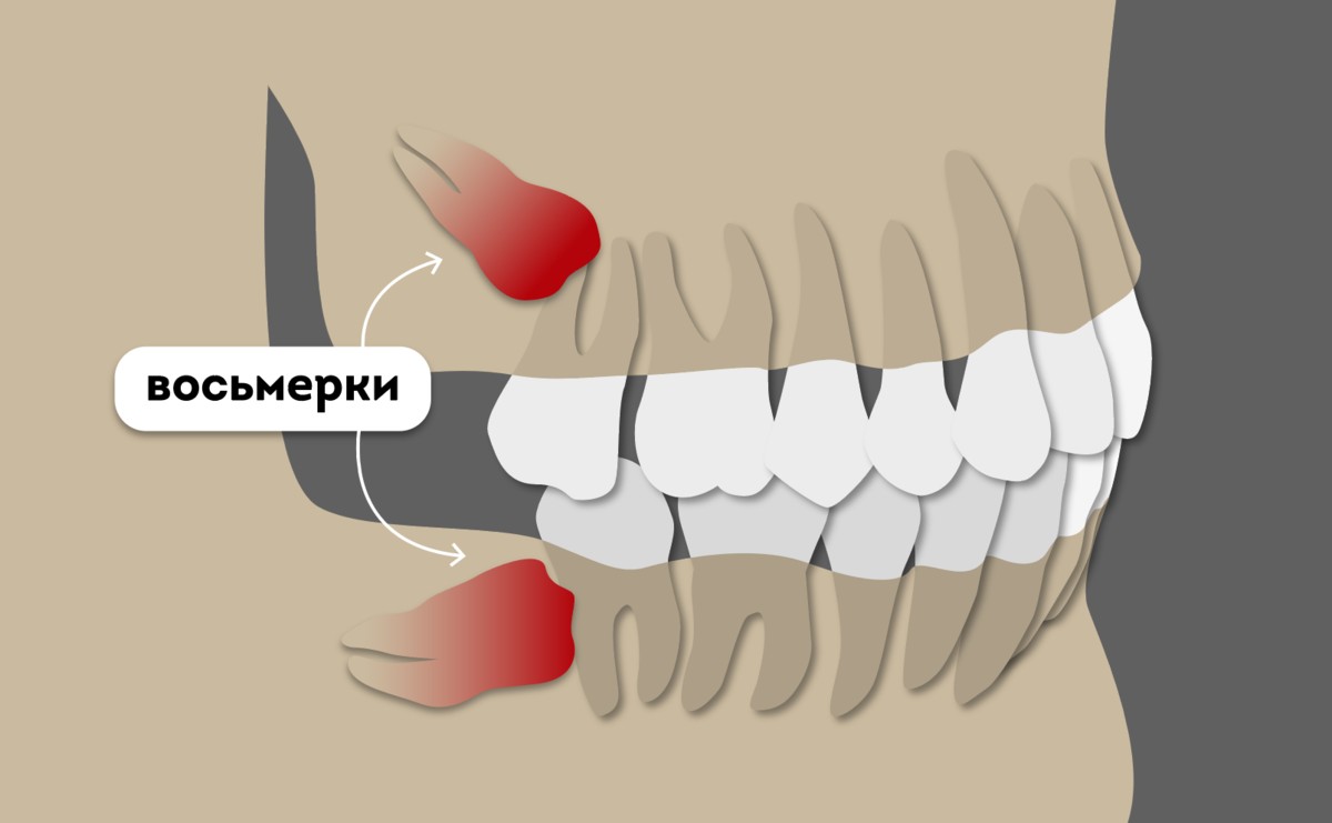 Непрорезавшиеся зубы мудрости, которые становятся причиной проблем с 7-ками и смещения зубного ряда. 
