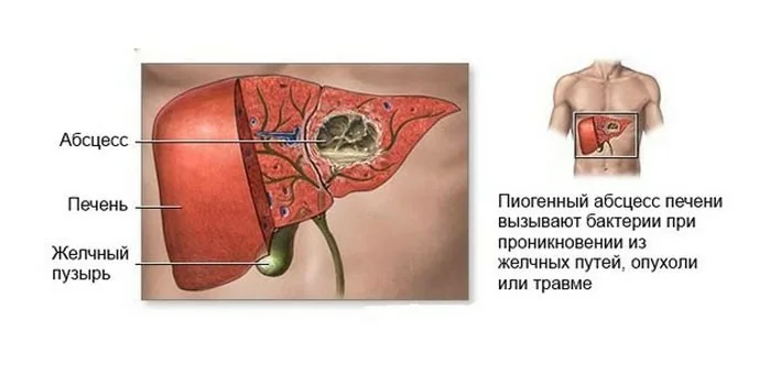 Абсцесс печени. Пиогенный абсцесс печени. Микробный абсцесс печени. Клинические проявления бактериальных абсцессов печени. Абсцесс печени этиология.