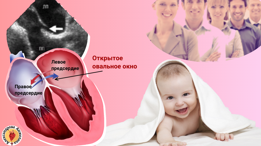Ное окно. Открытое овальное окно форум. Открытое овальное окно 6 мм у грудничка. Дефект межпредсердной перегородки на эхокг. Открытое овальное окно в сердце.