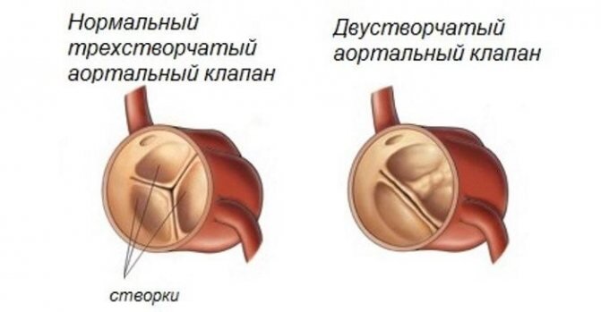 Клапанные патологии сердца