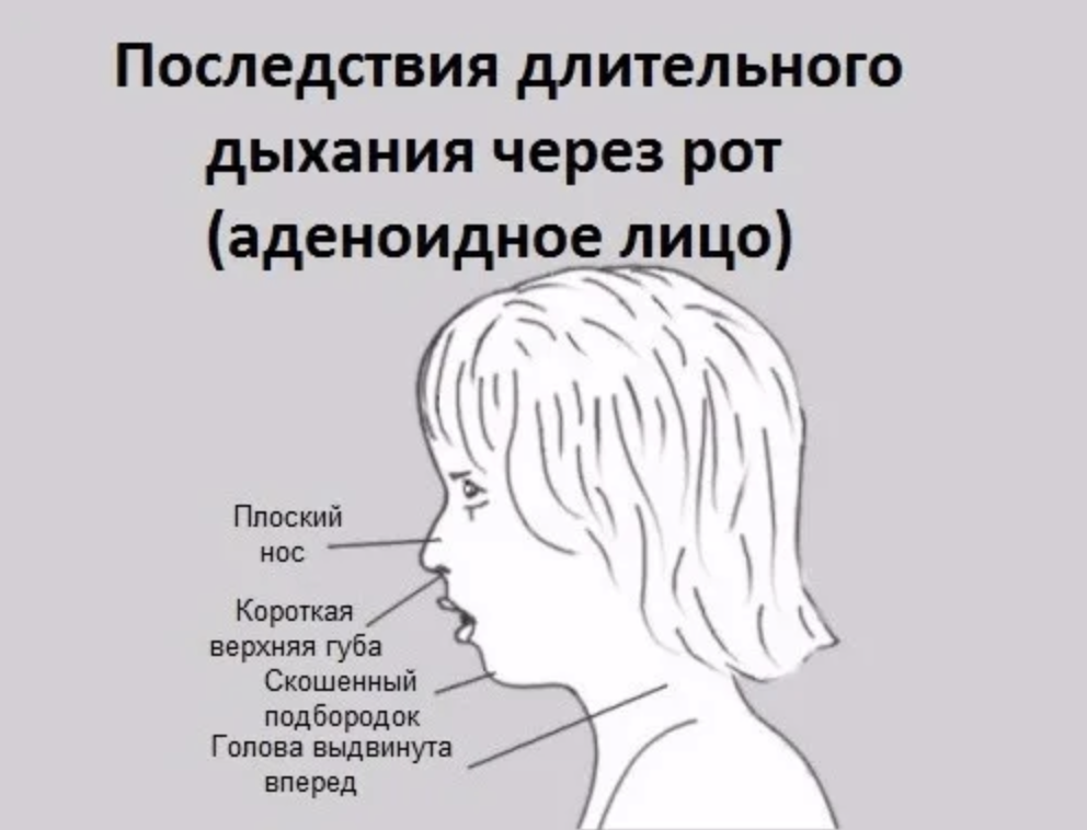 Симптомы аденоидов у детей. Аденоидный Тип лица у детей. Ротовой Тип дыхания у детей.