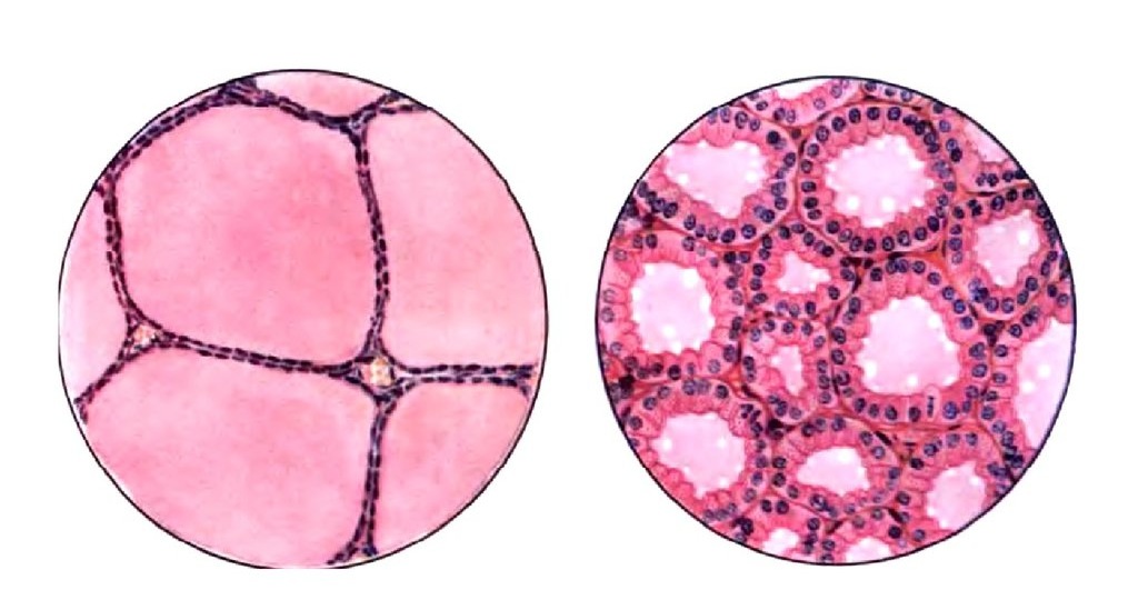 Высокий холестерин от "щитовидки"?