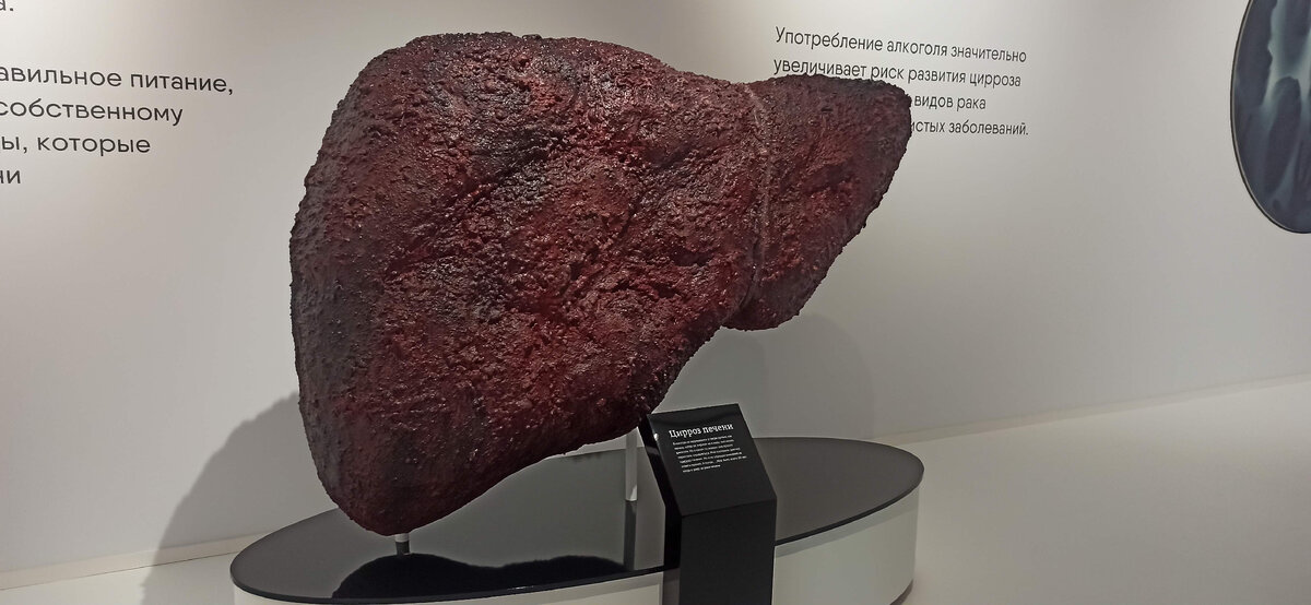 Употребление алкоголя значительно увеличивает риск цирроза.