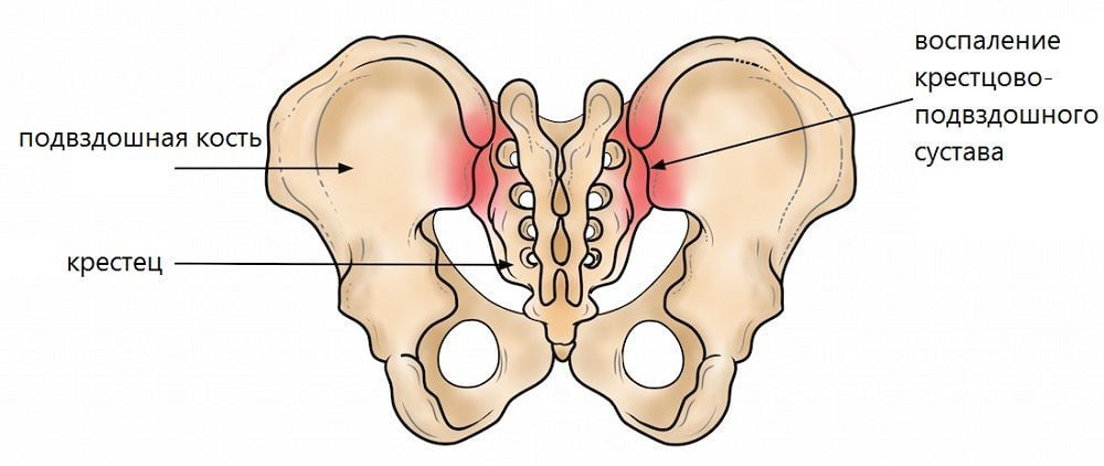 Сакроилеит: причины, симптомы. Лечение в Серпухове - Доктор Позвонков