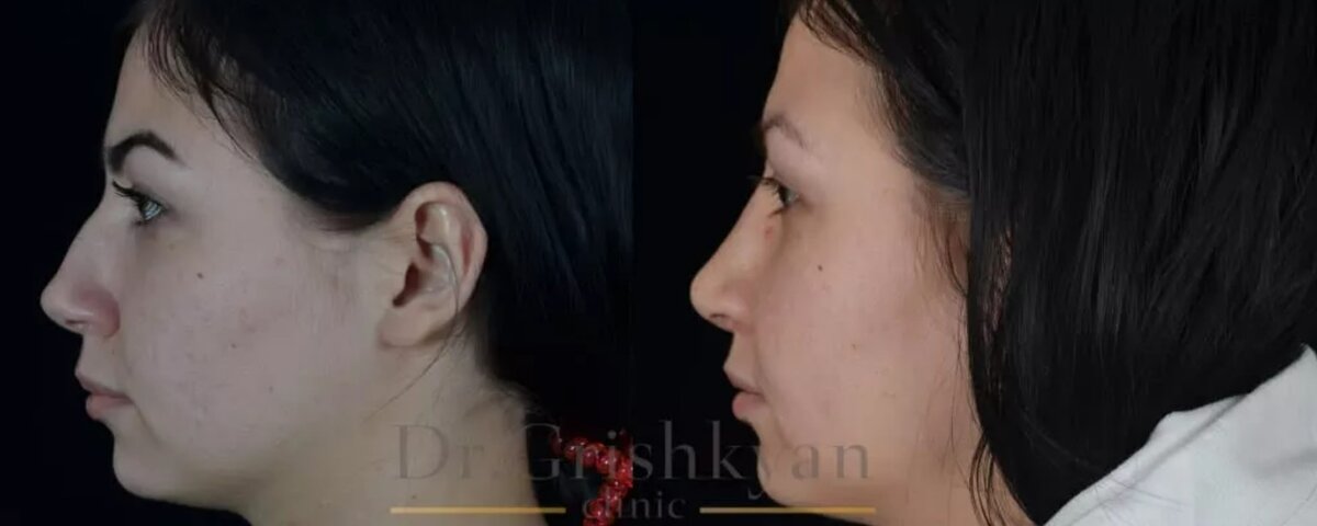 Повторная ринопластика носа. Исправили костно-хрящевую горбинку спинки, сузили концевые хрящи носа. Фото до и после. Фото с сайта Д.Р. Гришкяна. Имеются противопоказания, требуется консультация специалистов