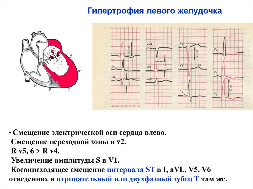 Гипертрофия левого и правого желудочка