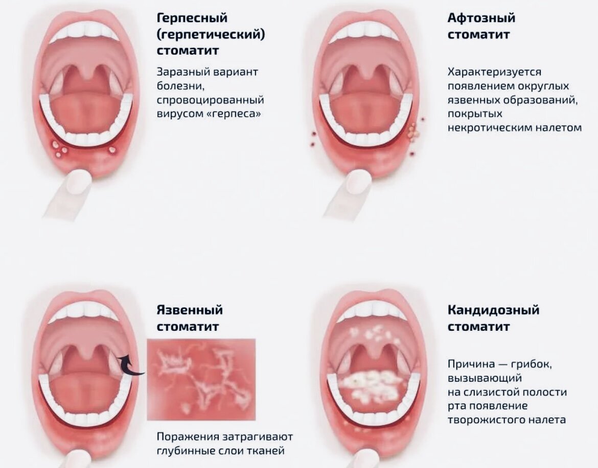 Как лечить рот ребенка. Стлпатит.