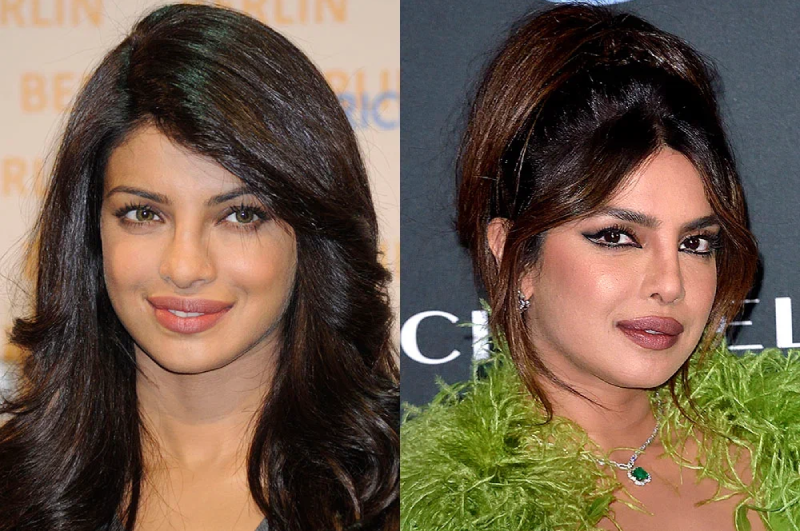 Приянка чопра до и после пластики Priyanka Chopra Opens On The 'Plastic Chopra' Tag After Surgery Went Wrong, "My