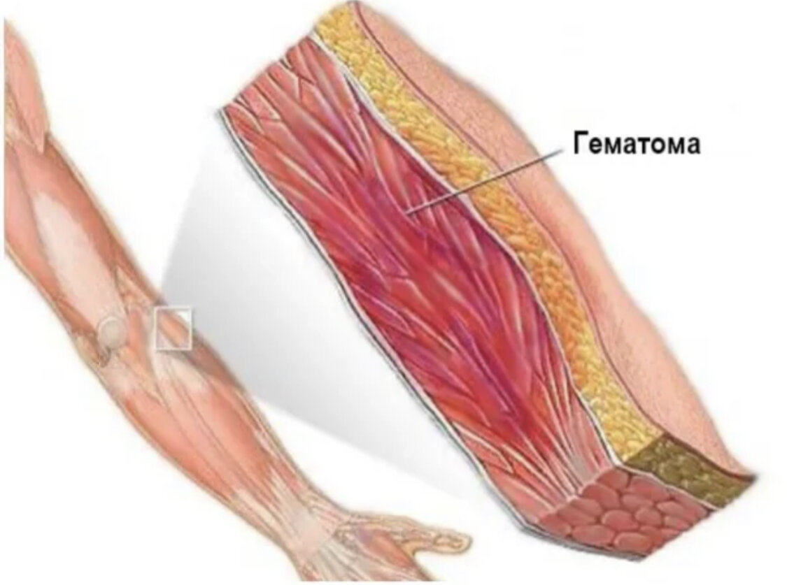Травма мышцы симптомы. Субфасциальная гематома. Подкожная гематома предплечье. Повреждение мышечной ткани.