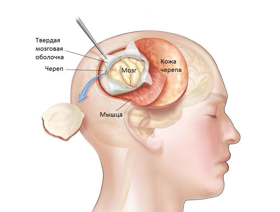 Мозговая кома причины. Мозговая кома. Биопсия головного мозга как проводится. Объемное образование головного мозга диагностика.