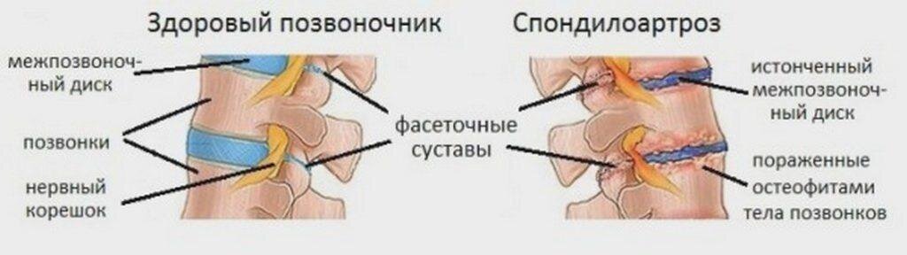 Инвалидность при спондилоартрозе поясничного отдела позвоночника