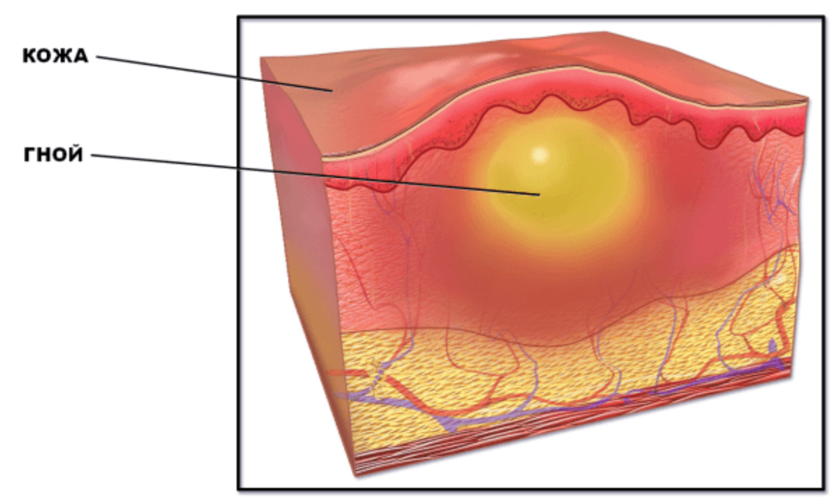 Как выглядит лечи. Абсцедирование фурункула. Фолликул фурункул карбункул. Абсцесс кожи фурункул и карбункул лица. Фурункул карбункул флегмона.