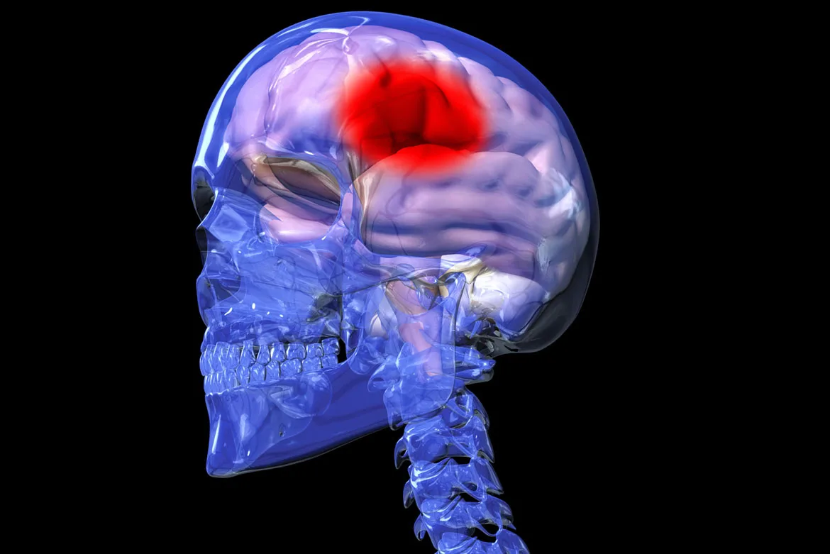 Мозг остановился. Кровоизлияние в головной мозг. Внутреннее кровотечение мозга.