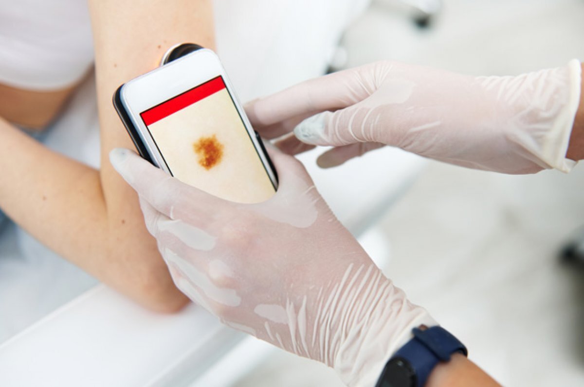    Невус и рак кожи.