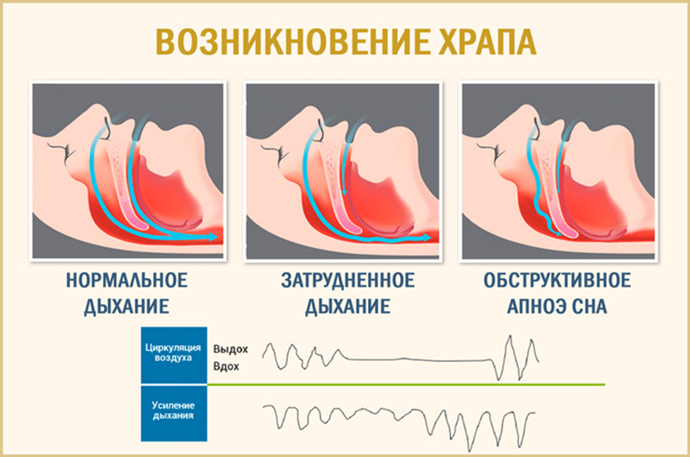 Храп отзывы форум